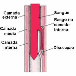 Dissecção da artéria vertebral