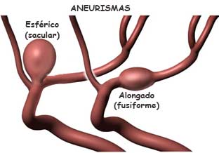 Dois Tipos de Aneurismas Intactos