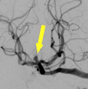 Aneurisma cerebral no exame de angiografia.