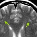 Ressonância magnética com focos inespecíficos e esparsos de hipersinal na substância branca, comuns em quem tem enxaqueca.